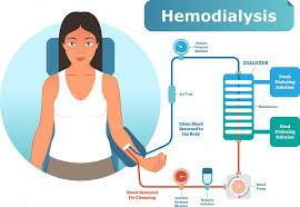 Understanding Dialysis: What It Is and What to Expect